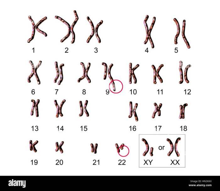 Chromosomes karyotype human homologous karyotypes normal 46 denver syndrome biology system chromosome trisomy pairing hunter pairs 2n definition genes pair